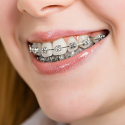 Types of Braces link