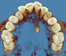 Mesiodens 1
