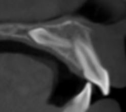 Mesiodens 2
